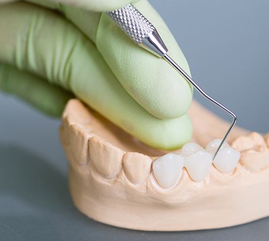 a closeup of a dental bridge