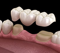 an illustration of a traditional dental bridge 