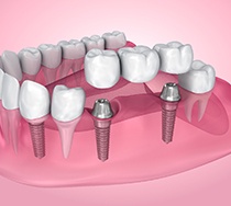 an illustration of an implant bridge