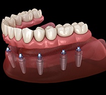 a digital illustration showing implant dentures