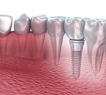 Digital illustration of a single dental implant in New Bedford, MA