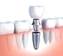 Illustration of implant, abutment, and crown between natural teeth