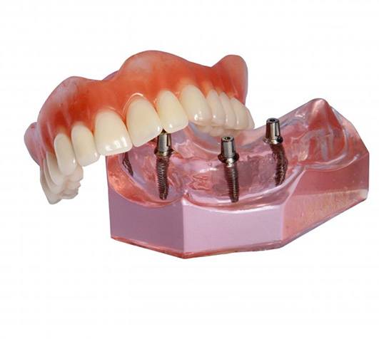 Model of implant dentures