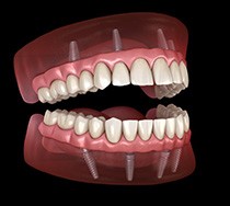 Illustration of fixed implant dentures