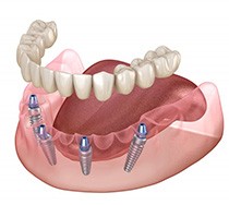 Illustration of removable dentures?
