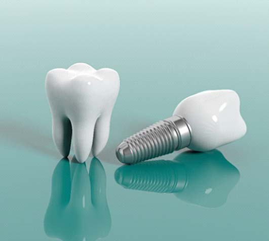 Diagram showing tooth next to dental implants in New Bedford