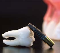 Dental implant post resting on top of a natural tooth