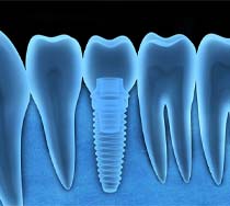 Diagram showing how dental implants work in New Bedford