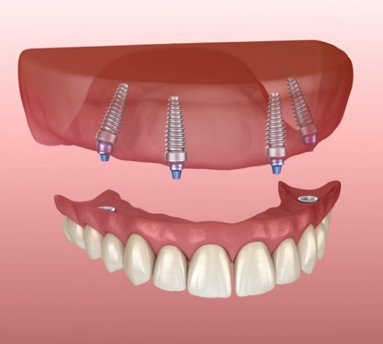 Animated dental implant supported denture