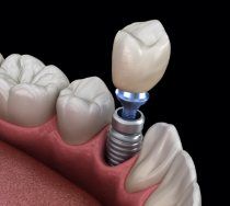 Animated dental implant supported dental crown placement