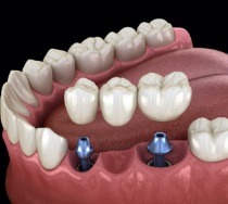 Animated dental implant supported fixed bridge placement