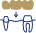 Animated smile with dental crown supported bridge