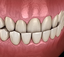 an example of underbite that needs Invisalign in New Bedford