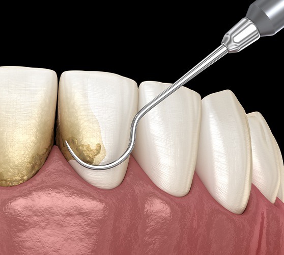 Animated smile during scaling and root planing treatment