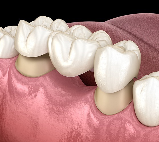 Animated smile during dental crown supported bridge placement