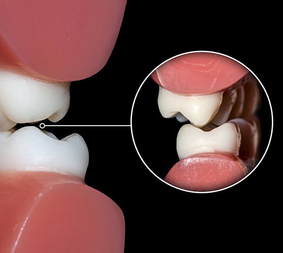 Closeup of smile in need of equilibration and occlusal adjustment