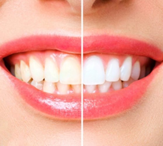 Closeup of patient's smile before and after teeth whitening