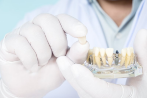 Dentist holding the crown of a model dental implant