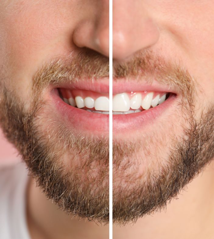 A man’s smile before and after gum recontouring treatment.