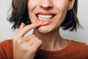 Woman pulling gum down to expose gums.